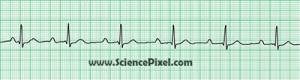 AV-Block 1. Grades (AV-Ueberleitungsstoerungen) / ECG, electrocardiogram