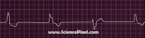 EKG Weak Action / ECG, electrocardiogram